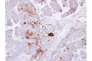 IHC-P Image Immunohistochemical analysis of paraffin-embedded OVCAR3 xenograft , using alkaline phosphatase (liver/bone/kidney), antibody at 1:100 dilution. (ALPL antibody  (Center))