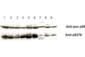 Anti-pS276 shows phospho p65 staining in carcinoma cells. (NF-kB p65 antibody  (pSer276))