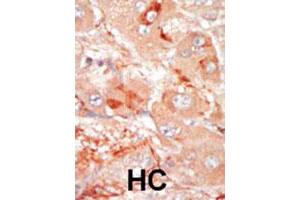 Formalin-fixed and paraffin-embedded human hepatocellular carcinoma tissue reacted with the PRPF4B polyclonal antibody , which was peroxidase-conjugated to the secondary antibody, followed by DAB staining. (PRPF4B antibody  (C-Term))