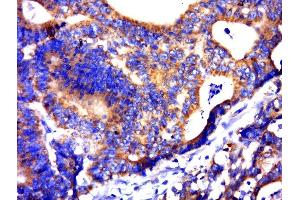 Paraformaldehyde-fixed, paraffin embedded human colon carcinoma, Antigen retrieval by boiling in sodium citrate buffer (pH6. (C21orf62 antibody)