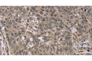 Immunohistochemistry of paraffin-embedded Human lung cancer tissue using IL15RA Polyclonal Antibody at dilution 1:45 (IL15RA antibody)