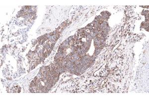 IHC-P Image Immunohistochemical analysis of paraffin-embedded human ovarian cancer, using NDUFS4, antibody at 1:100 dilution. (NDUFS4 antibody  (Center))