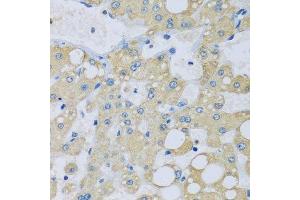 Immunohistochemistry of paraffin-embedded human liver injury using NDUFA7 antibody.