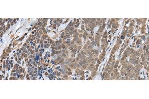 Immunohistochemistry of paraffin-embedded Human thyroid cancer tissue using ZNF410 Polyclonal Antibody at dilution of 1:40(x200) (ZNF410 antibody)