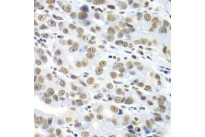 Immunohistochemistry of paraffin-embedded human gastric cancer using HDAC2 antibody. (HDAC2 antibody  (C-Term))