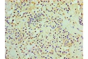 Immunohistochemistry of paraffin-embedded human breast cancer using ABIN7167634 at dilution of 1:100 (RMDN3 antibody  (AA 1-470))