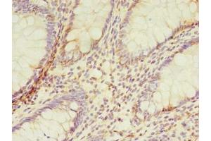 Immunohistochemistry of paraffin-embedded human colon cancer using ABIN7173091 at dilution of 1:100 (TMEM165 antibody  (AA 173-228))