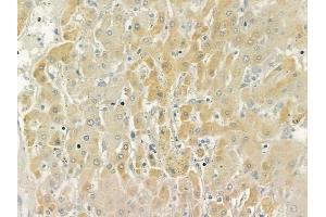 ABIN6258978 and ABIN6276019 at 1/100 staining human hepatocellular carcinoma by IHC-P. (GPR158 antibody  (N-Term))