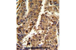 Formalin-fixed and paraffin-embedded mouse hepatocarcinoma reacted withAP17686PU-N PSME2 Antibody (C-term), which was peroxidase-conjugated to the secondary antibody (PSME2 antibody  (C-Term))