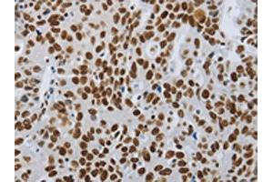 The image on the left is immunohistochemistry of paraffin-embedded Human ovarian cancer tissue using ABIN7192399(SLC16A14 Antibody) at dilution 1/80, on the right is treated with synthetic peptide.