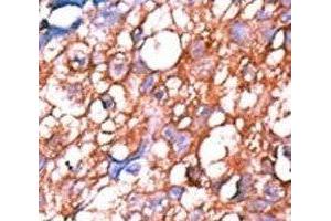 IHC analysis of FFPE human hepatocarcinoma tissue stained with the phospho-ERBB4 antibody. (ERBB4 antibody  (pTyr1162))