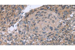 Immunohistochemistry of paraffin-embedded Human cervical cancer using p53RFP Polyclonal Antibody at dilution of 1:50 (RNF144B antibody)