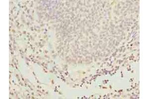 Immunohistochemistry of paraffin-embedded human bladder cancer using ABIN7154238 at dilution of 1:100 (GLT1D1 antibody  (AA 17-152))