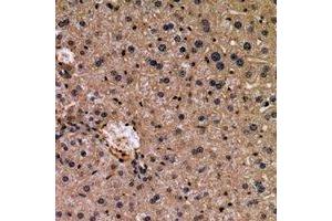 Immunohistochemical analysis of WISP3 staining in human liver cancer formalin fixed paraffin embedded tissue section.