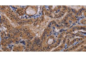 Immunohistochemistry of paraffin-embedded Human thyroid cancer using MCTS1 Polyclonal Antibody at dilution of 1:60 (MCTS1 antibody)