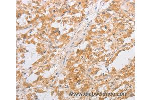 Immunohistochemistry of Human thyroid cancer using CDKN2AIP Polyclonal Antibody at dilution of 1:40 (CDKN2AIP antibody)
