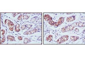 Immunohistochemical analysis of paraffin-embedded human stomach cancer tissues using PGA5 mouse mAb with DAB staining. (PGA5 antibody)