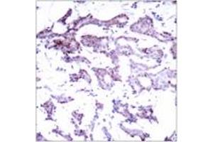 Immunohistochemistry analysis of paraffin-embedded human breast carcinoma tissue, using Elk1 (Ab-389) Antibody. (ELK1 antibody  (AA 356-405))