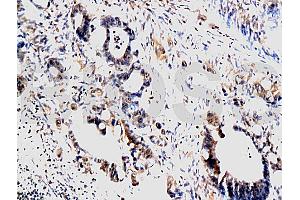 Formalin-fixed and paraffin embedded human colon carcinoma labeled with Anti-MMP-1 Polyclonal Antibody, Unconjugated (ABIN668931) at 1:200, followed by conjugation to the secondary antibody and DAB staining (MMP1 antibody  (AA 401-464))