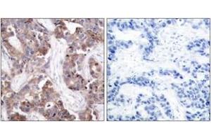 Immunohistochemistry analysis of paraffin-embedded human breast carcinoma, using Stathmin 1 (Phospho-Ser24) Antibody.