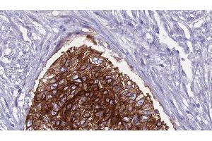 ABIN6276812 at 1/100 staining Human urothelial cancer tissue by IHC-P. (SLC22A5 antibody  (C-Term))