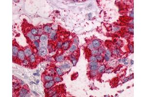 Anti-NTSR1 / NTR antibody IHC of human Lung, Adenocarcinoma. (NTSR1 antibody  (N-Term))
