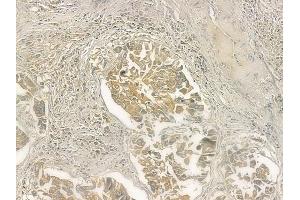 ABIN6258523 and ABIN6274745 at 1/100 staining human lung squamous cell carcinoma by IHC-P.