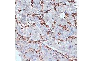 Immunohistochemistry of paraffin-embedded human liver cancer using HLA-DRA antibody (ABIN6131757, ABIN6141827, ABIN6141829 and ABIN6215475) at dilution of 1:100 (40x lens). (HLA-DRA antibody  (AA 26-216))