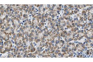 ABIN6274603 at 1/100 staining Human liver cancer tissue by IHC-P. (P-Cadherin antibody  (N-Term))