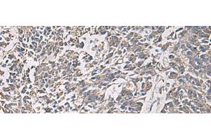 Immunohistochemistry of paraffin-embedded Human colorectal cancer tissue using PRKCSH Polyclonal Antibody at dilution of 1:90(x200) (PRKCSH antibody)