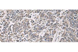 Immunohistochemistry of paraffin-embedded Human colorectal cancer tissue using PRKCSH Polyclonal Antibody at dilution of 1:90(x200)