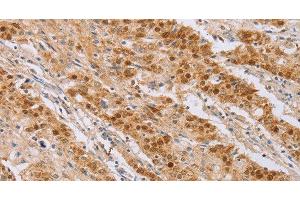 Immunohistochemistry of paraffin-embedded Human gastic cancer using CDC46 Polyclonal Antibody at dilution of 1:40 (MCM5 antibody)