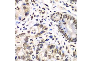 Immunohistochemistry of paraffin-embedded human gastric cancer using RBBP7 antibody.