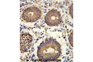 Immunohistochemistry (IHC) image for anti-Carcinoembryonic Antigen Gene Family (CEA) antibody (ABIN3002653)