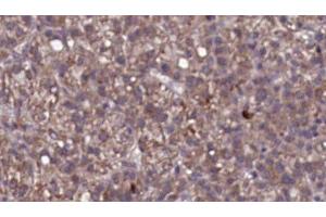 ABIN6276764 at 1/100 staining Human liver cancer tissue by IHC-P. (IL23R antibody  (N-Term))