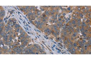 Immunohistochemistry of paraffin-embedded Human ovarian cancer tissue using OTOR Polyclonal Antibody at dilution 1:30 (Otoraplin antibody)