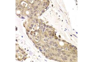 Immunohistochemistry of paraffin-embedded human colon carcinoma using FKBP4 Antibody (ABIN5973289) at dilution of 1/200 (40x lens). (FKBP4 antibody)