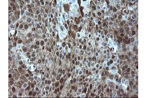 Immunohistochemical staining of paraffin-embedded Carcinoma of Human lung tissue using anti-ADH7 mouse monoclonal antibody.