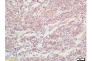 Formalin-fixed and paraffin embedded human lung carcinoma labeled with Rabbit Anti ZNF268 Polyclonal Antibody, Unconjugated  at 1:200 followed by conjugation to the secondary antibody and DAB staining (ZNF268 antibody  (AA 286-358))