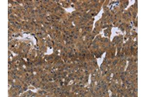 The image on the left is immunohistochemistry of paraffin-embedded Human ovarian cancer tissue using ABIN7191253(LAIR2 Antibody) at dilution 1/20, on the right is treated with synthetic peptide. (LAIR2 antibody)