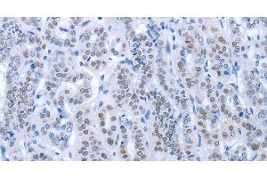 Immunohistochemistry of paraffin-embedded Human thyroid cancer using PAX8 Polyclonal Antibody at dilution of 1:35 (PAX8 antibody)