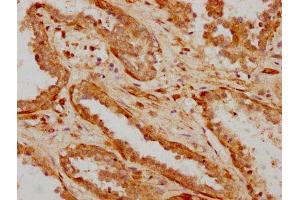IHC image of ABIN7156114 diluted at 1:600 and staining in paraffin-embedded human prostate cancer performed on a Leica BondTM system. (ILDR1 antibody  (AA 393-541))