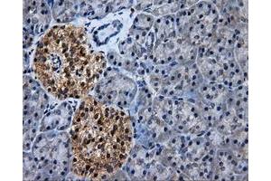 Immunohistochemical staining of paraffin-embedded Adenocarcinoma of colon tissue using anti-HSD17B10mouse monoclonal antibody.