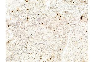 ABIN6256660 and ABIN6267226 at 1/100 staining Human lung cancer by IHC-P.