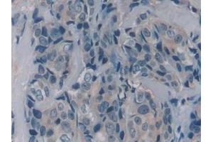 Detection of PRSS1 in Human Breast cancer Tissue using Polyclonal Antibody to Protease, Serine 1 (PRSS1) (PRSS1 antibody  (AA 51-228))