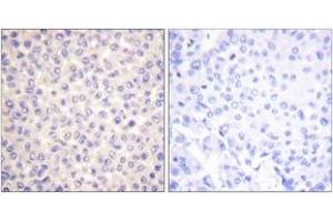 Immunohistochemistry analysis of paraffin-embedded human breast carcinoma, using FADD (Phospho-Ser194) Antibody. (FADD antibody  (pSer194))