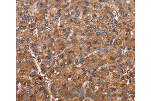 Immunohistochemistry of Human colon cancer using ELP2 Polyclonal Antibody at dilution of 1:40 (ELP2 antibody)