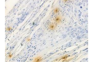 ABIN6257001 and ABIN6274697 at 1/100 staining human tongue carcinoma by IHC-P. (PHLDA1 antibody  (N-Term))
