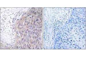 Immunohistochemistry analysis of paraffin-embedded human cervix carcinoma tissue, using POLG2 Antibody. (POLG2 antibody  (AA 291-340))
