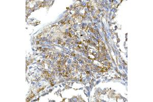 Immunohistochemistry of paraffin-embedded human lung cancer using RPL13 Rabbit mAb (ABIN7269993) at dilution of 1:50 (40x lens). (RPL13 antibody)